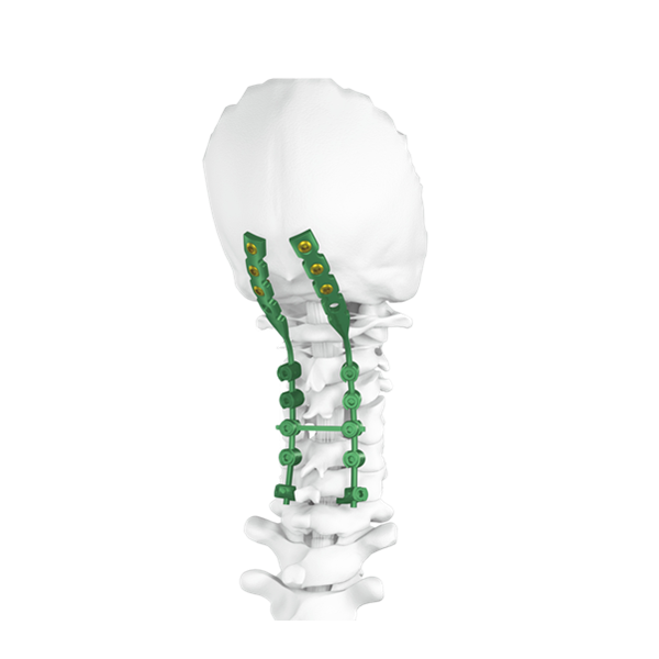 Oksipital posterior sistem sekrup tulang belakang serviks